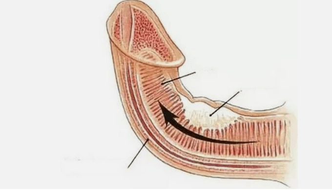 Elimination of venous outings